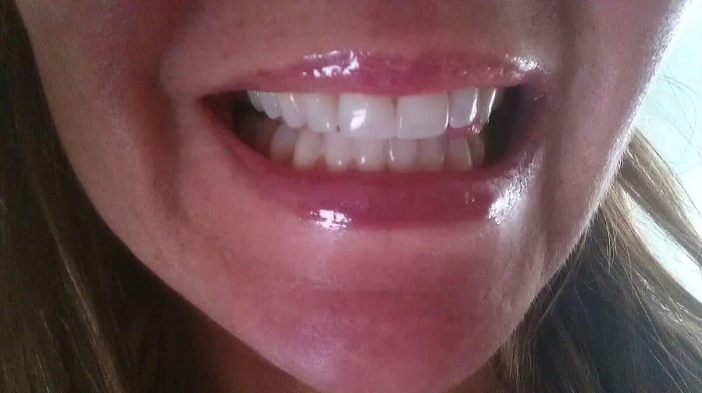 pearl brite teeth whitening reviews